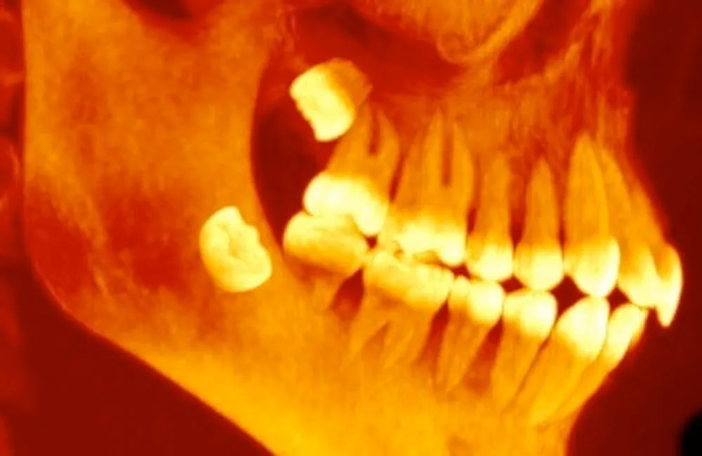 Bussel Teeth Why Do Humans Still Have Wisdom Teeth? Evolution Explains