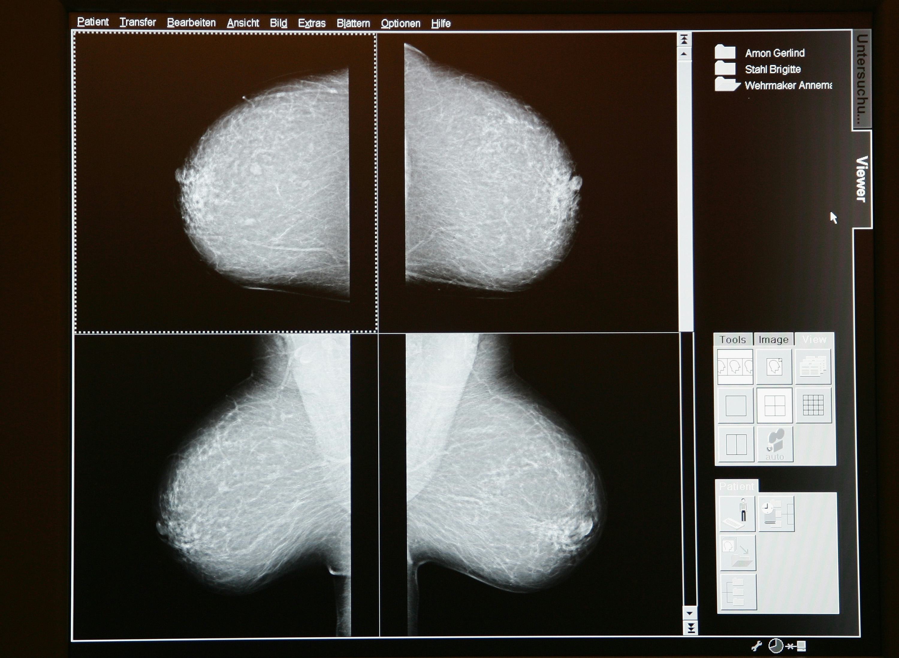 How Often Should You Get Mammograms? The Answer Depends On Your Age