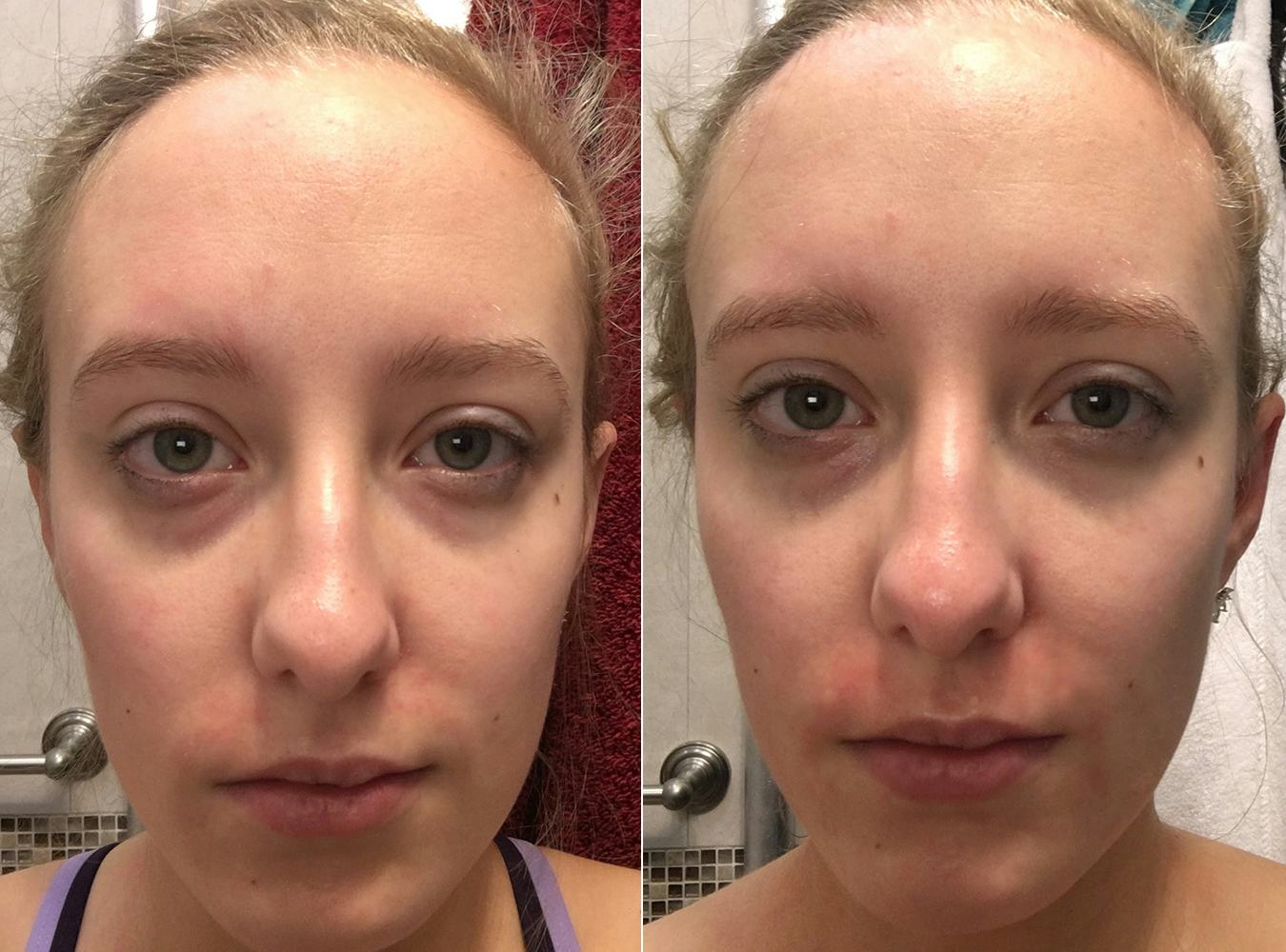 I Tried Every Eye DePuffing Hack Out There & This Is What Happened