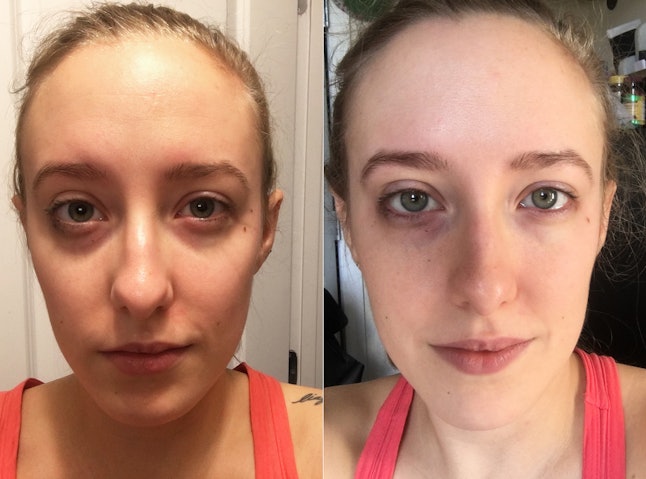 Image result for before and after puffy eyes