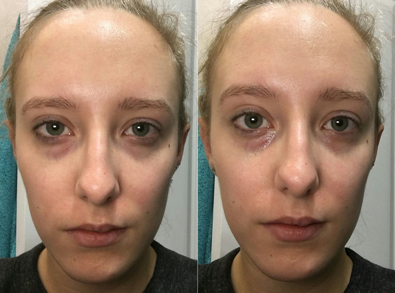 I Tried Every Eye DePuffing Hack Out There & This Is What Happened