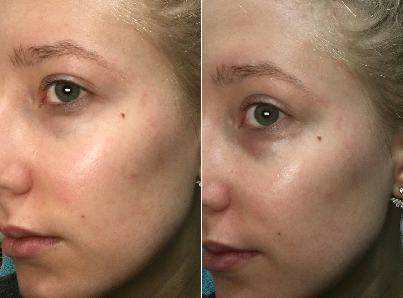 I Tried Every Eye DePuffing Hack Out There & This Is What Happened