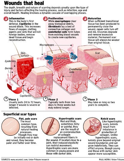 eczema home treatment salt