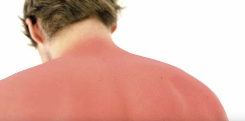 Why Do We Get Sunburns? Science Says It's Our Own Fault, Not The Sun's