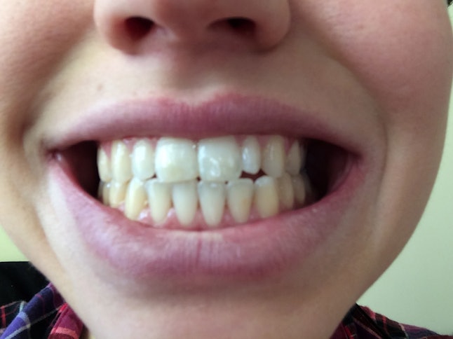 Does Oil Pulling Work To Whiten Your Teeth? I Tried It For ...