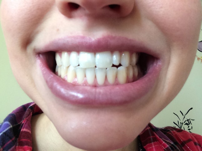teeth pulling oil whiten does week tried happened
