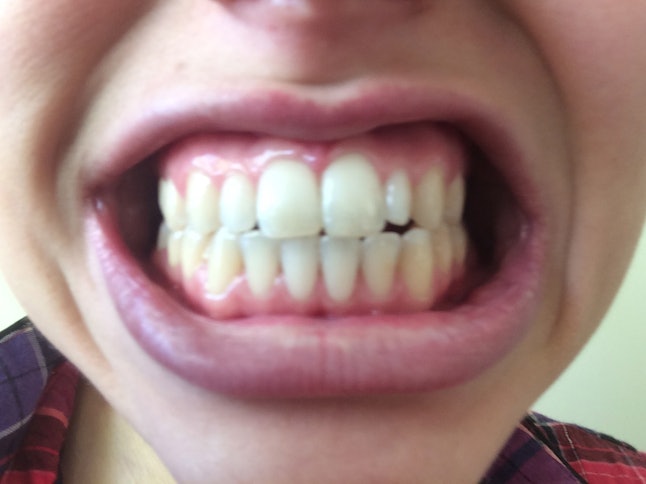 Does Oil Pulling Work To Whiten Your Teeth? I Tried It For a Week, and Here's What Happened