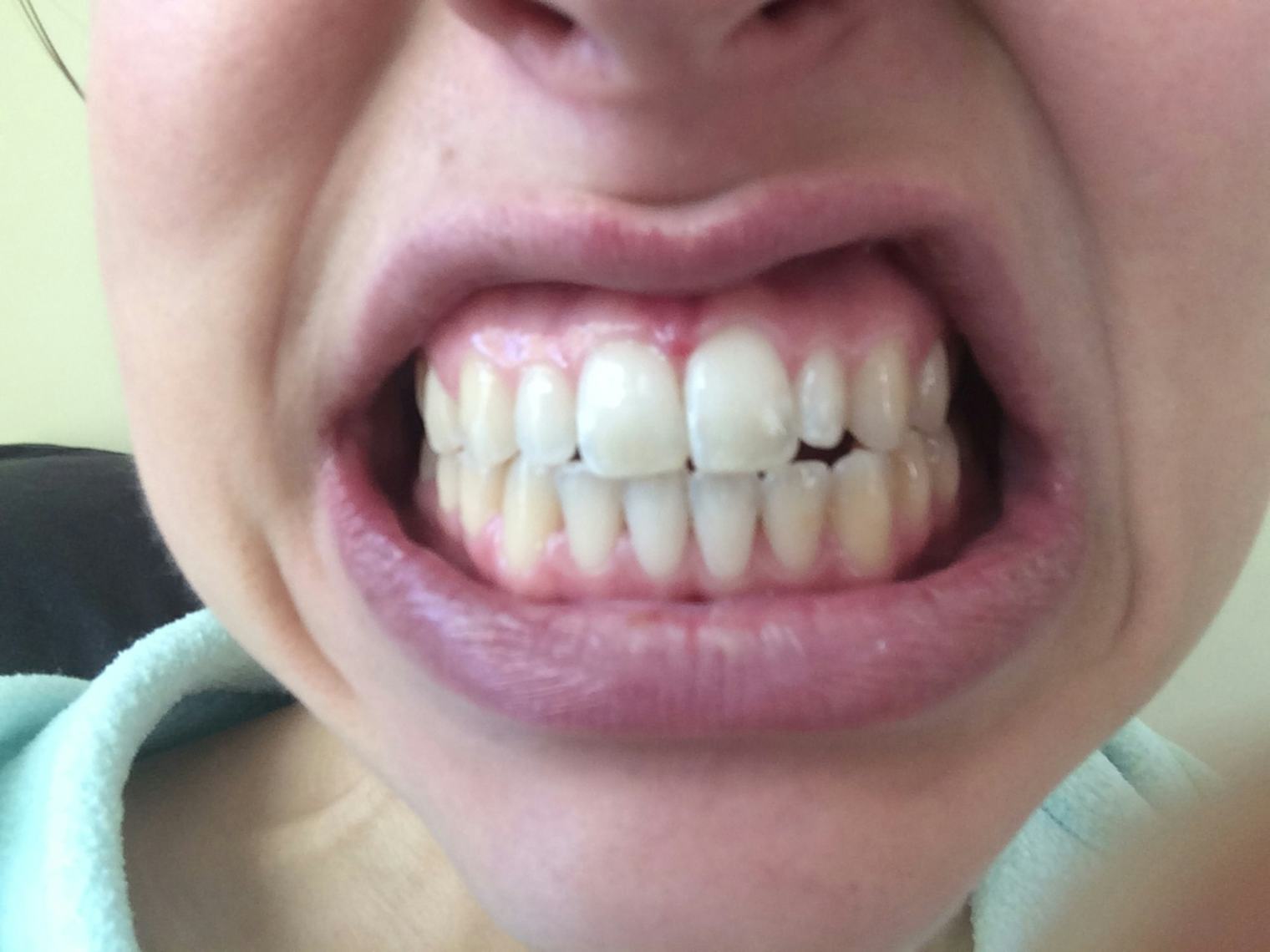Does Oil Pulling Work To Whiten Your Teeth? I Tried It For a Week, and Here's What Happened