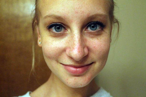 for oil zits face I Oil Face Coconut My Treat Attempts With In My Washed To for oil zits face I Oil Face Coconut My Treat Attempts With In My Washed To