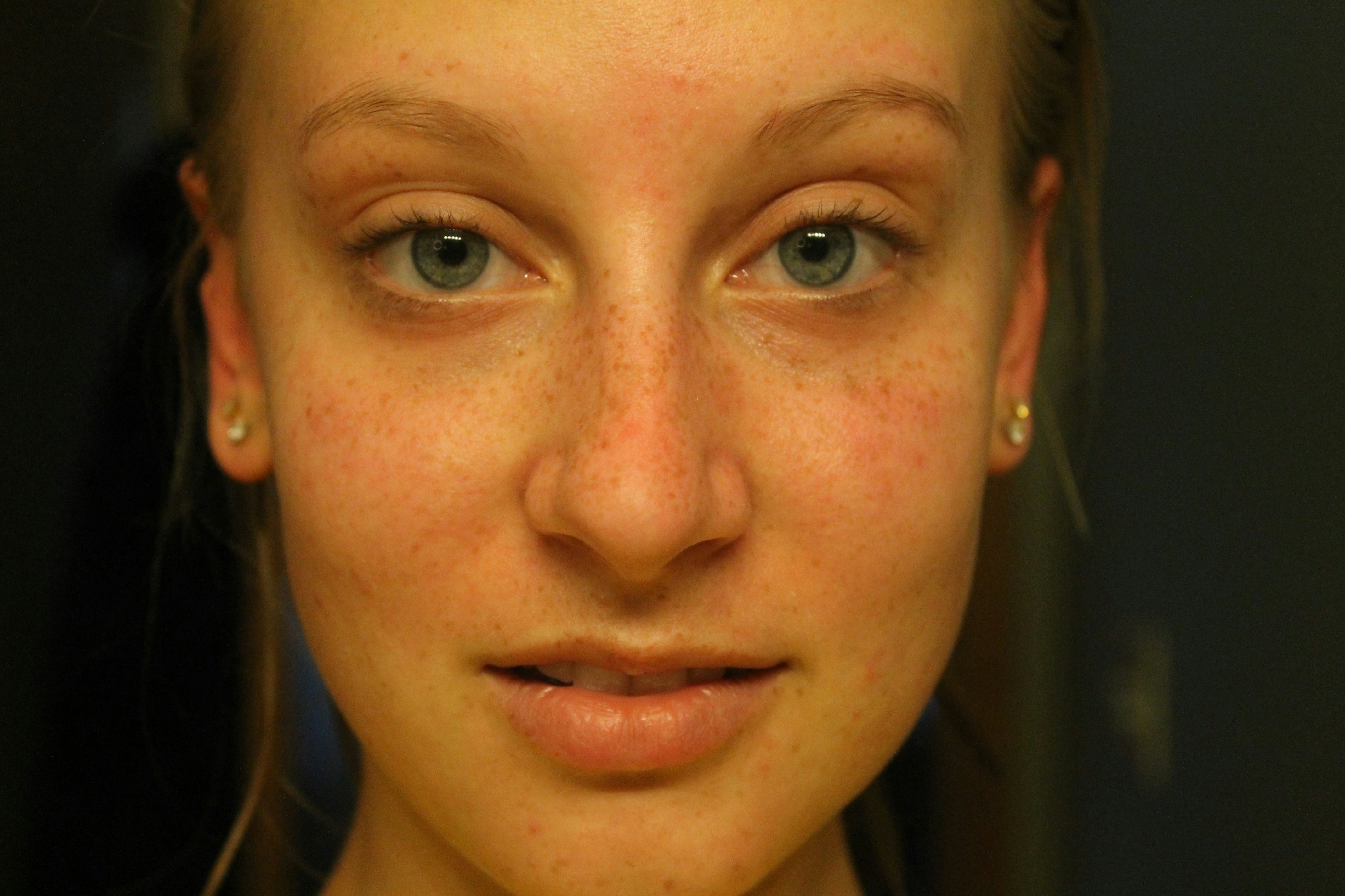 I Washed My Face With Coconut Oil In Attempts To Treat My Very Stubborn