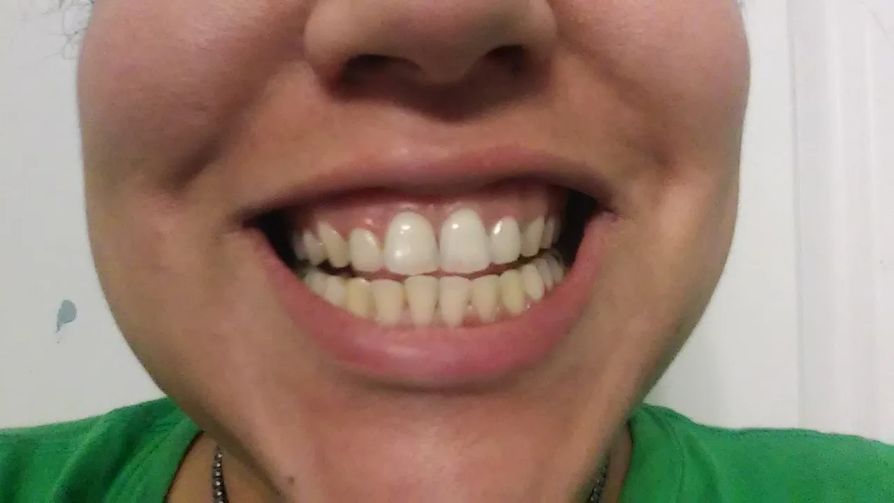 Does Activated Charcoal Whiten Teeth? I Brushed With It For A Week