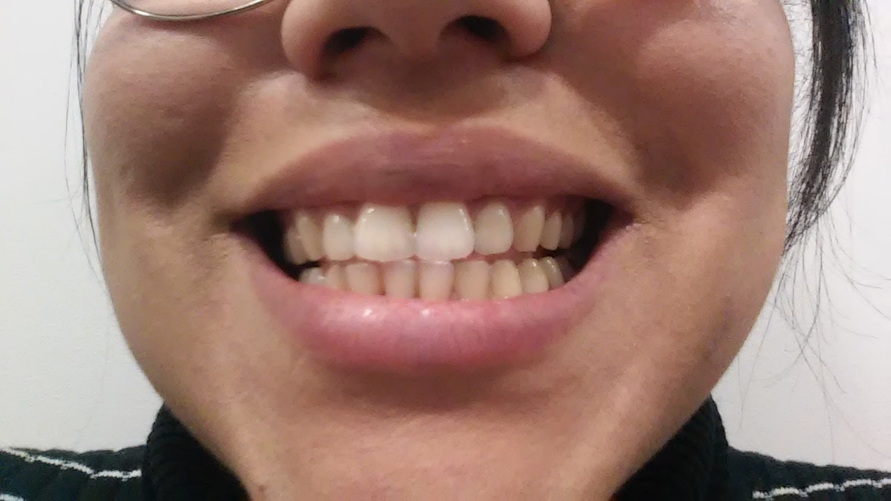 chalfens white teeth