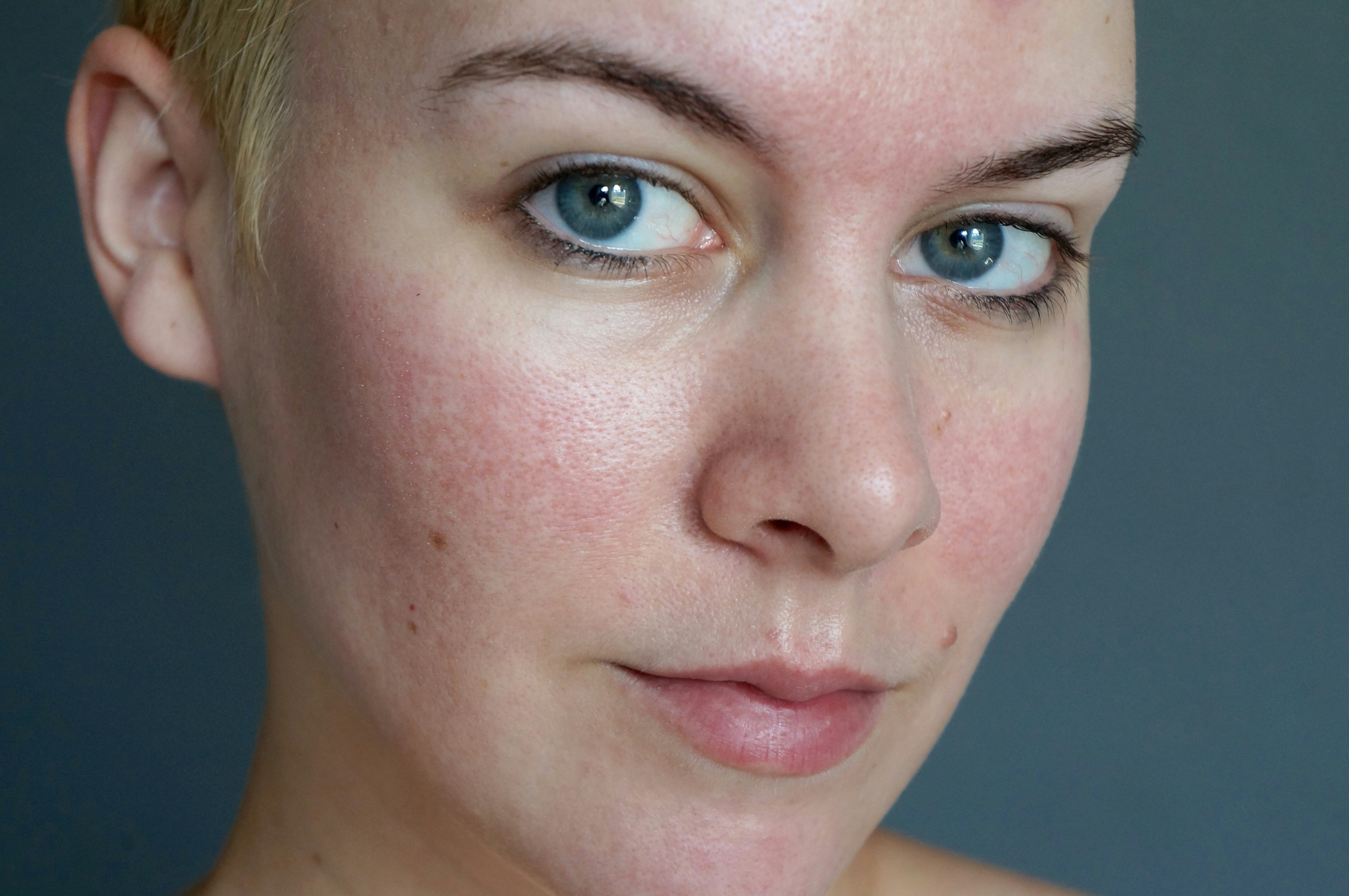 I Tried Adding Sulfur To My Skin Care Routine To Reduce The Redness On