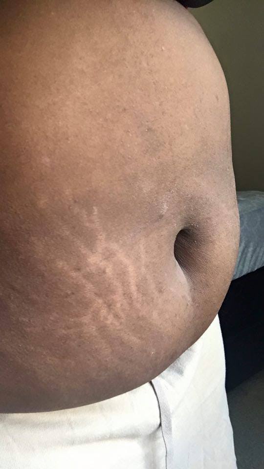 13 Women Showing Off Their Scars & Skin Conditions With No Apology — PHOTOS