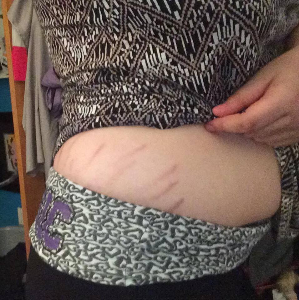 stretch marks on arms stretch marks on arms