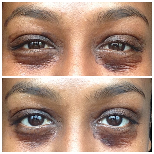 My Chemical Peel Before & After Photos Make The ZombieLike Healing