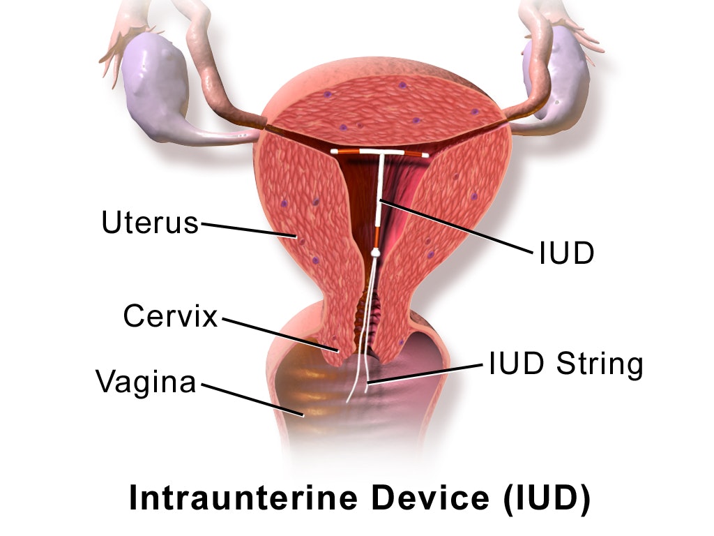 Bleeding after sex with an IUD: What to know