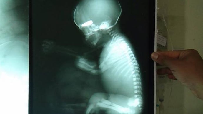 A doctor holding an x-ray of a baby with a bullet in its head