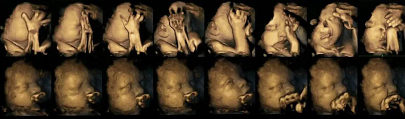 fetal cigarette syndrome Effects of Smoking During Pregnancy Disturbing Images of Fetuses Reveal