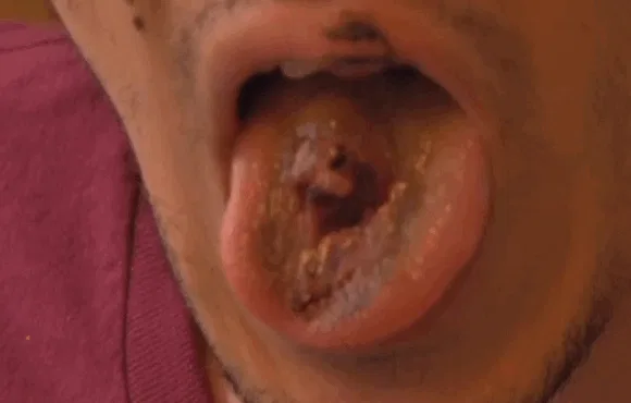 burnt tongue from vape Exploding Vapes Are Becoming More Common and Causing Serious Injuries
