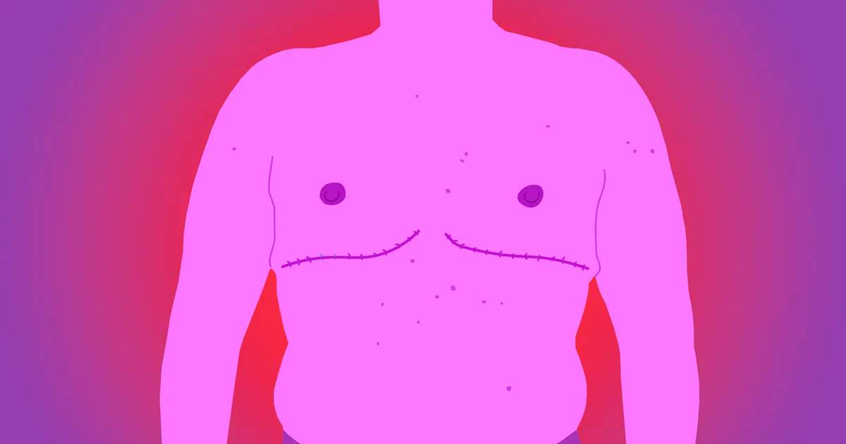 Topectomie What To Know About Top Surgery