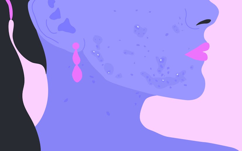 How does Accutane work permanently?