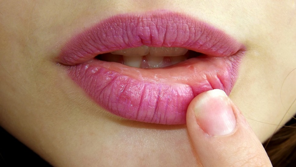herpes oral blisters