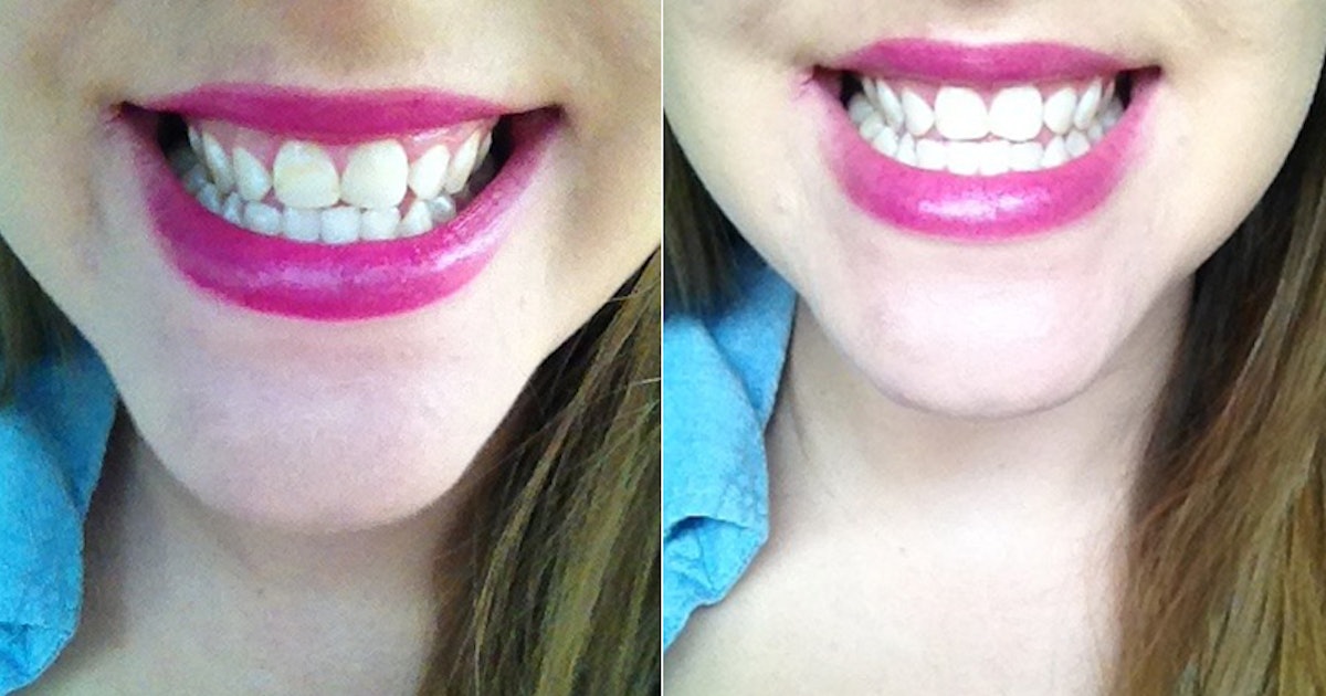 I Tried At-Home Teeth Whitening Methods Pinterest ...