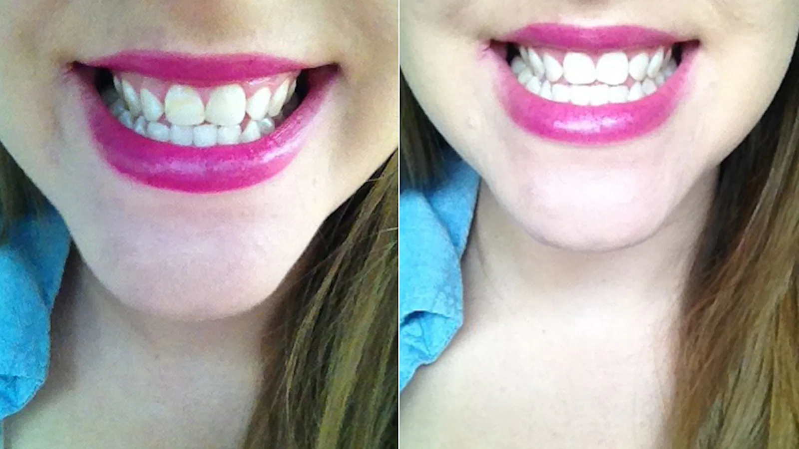 I Tried AtHome Teeth Whitening Methods Pinterest
