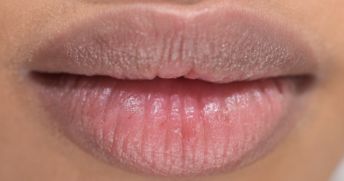 what does severely chapped lips mean what does severely chapped lips mean