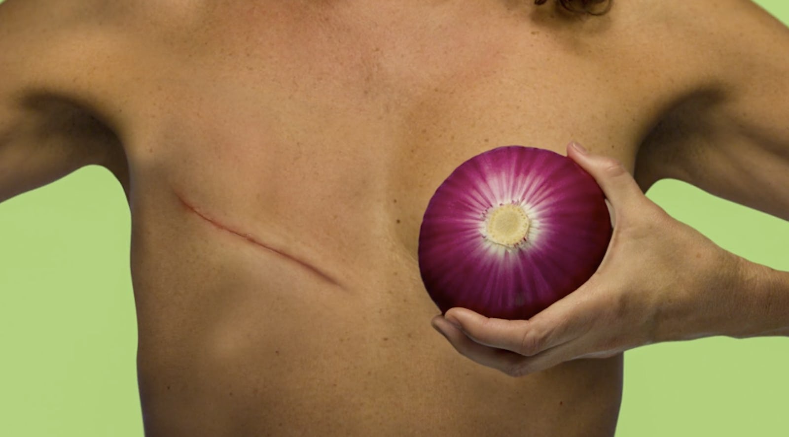 злокачественная опухоль в груди у женщин фото 90