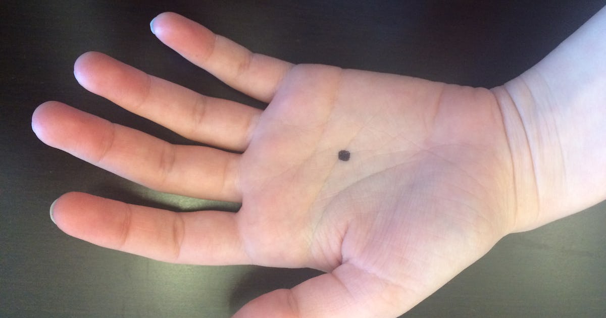 Меланома на руке фото Меланома на руке фото