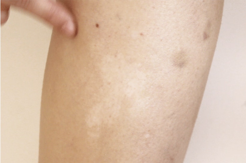 vitiligo arms patches legs event special summer tutorial bustle entertainment jun