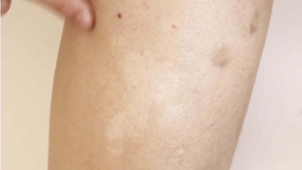 vitiligo arms patches legs event special summer tutorial bustle entertainment jun