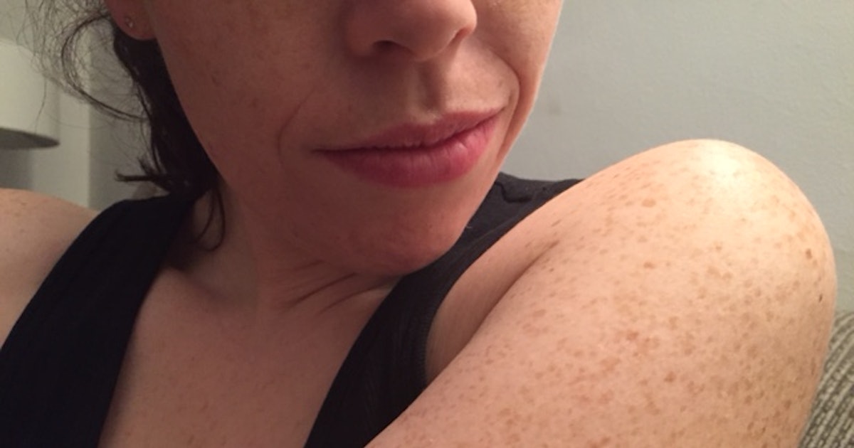 Those Bumps On Your Upper Arms Are Called Keratosis Pilaris, And They're  More Common Than You Think