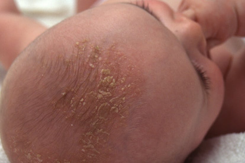 Cradle cap baby