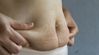 A woman holding her post-baby belly with stretch marks on both sides 
