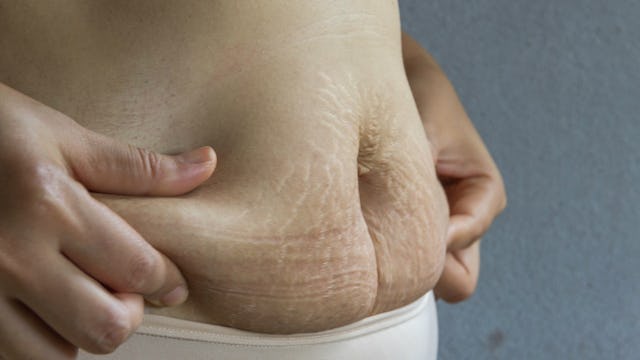 A woman holding her post-baby belly with stretch marks on both sides