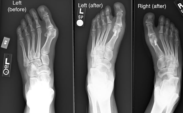A three-part collage of an X-Ray of a foot