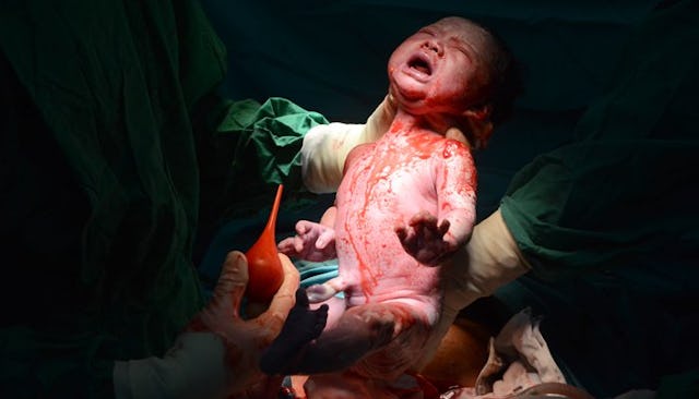 Newborn covered in blood after a C-section