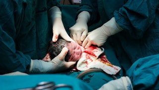 Newborn baby immediately after birth surrounded by doctors