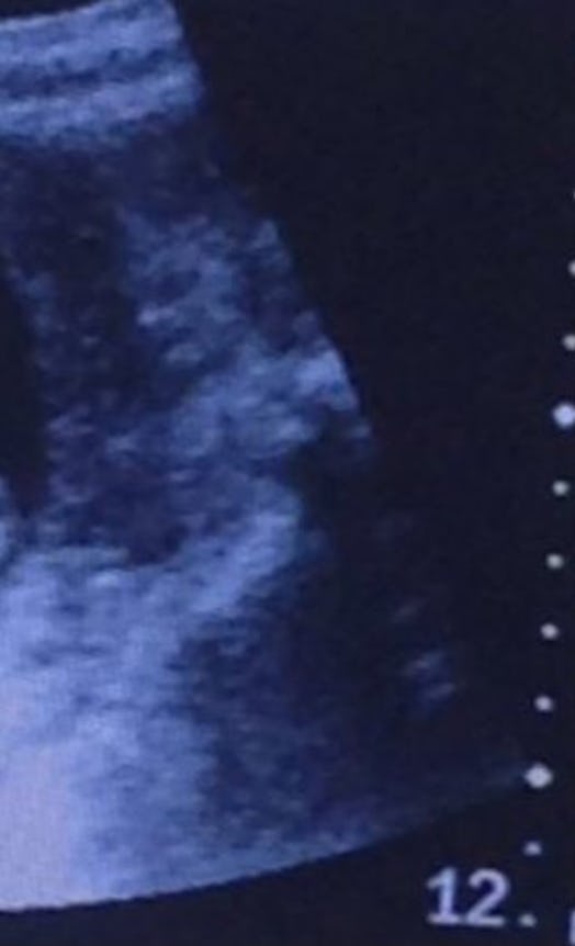 ultrasound-with-demon-in-it-close-up-of-demon