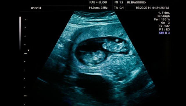 miscarriage twins