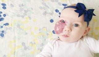 infant with birthmark