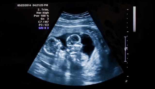 having twins