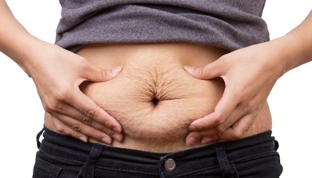 postpartum diastasis Recti