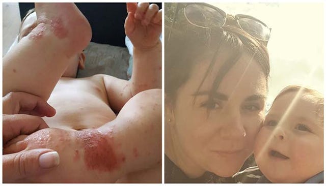 A mom showing the herpes rash on her baby after a kiss from someone with a cold sore.
