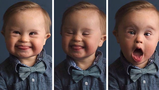 down syndrome