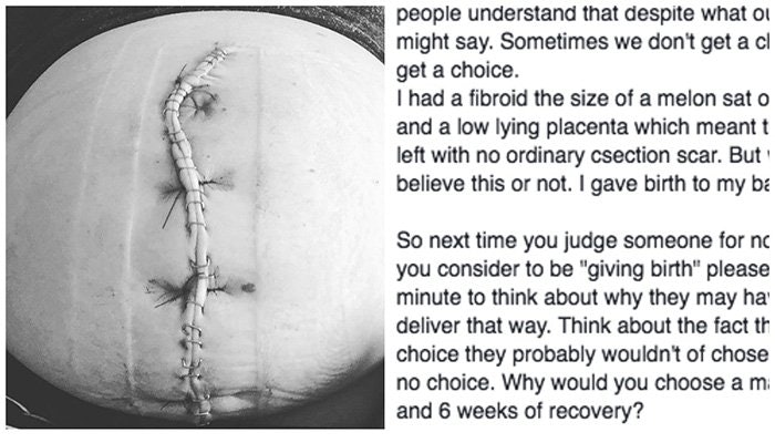 Hey C-Section Mom, You're A Badass