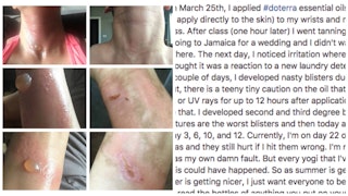 A collage of six pictures depicting a woman's burns from essential oils and a text with her explanat...